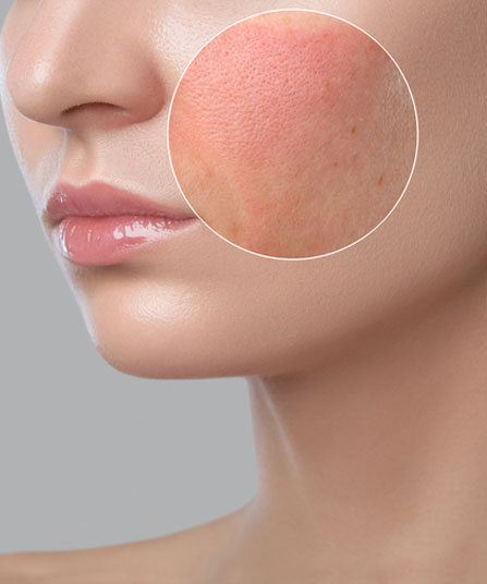 Rosacea Laser Treatment Melbourne / Redness | Melbourne Laser