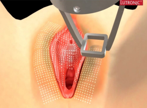 Fractional Laser Vulva