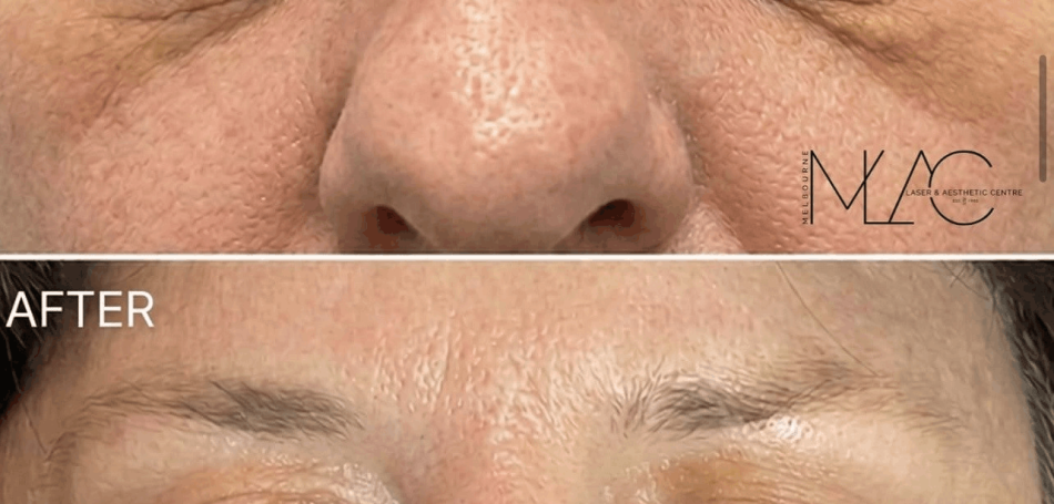 Xanthelasma Removal Melbourne Image