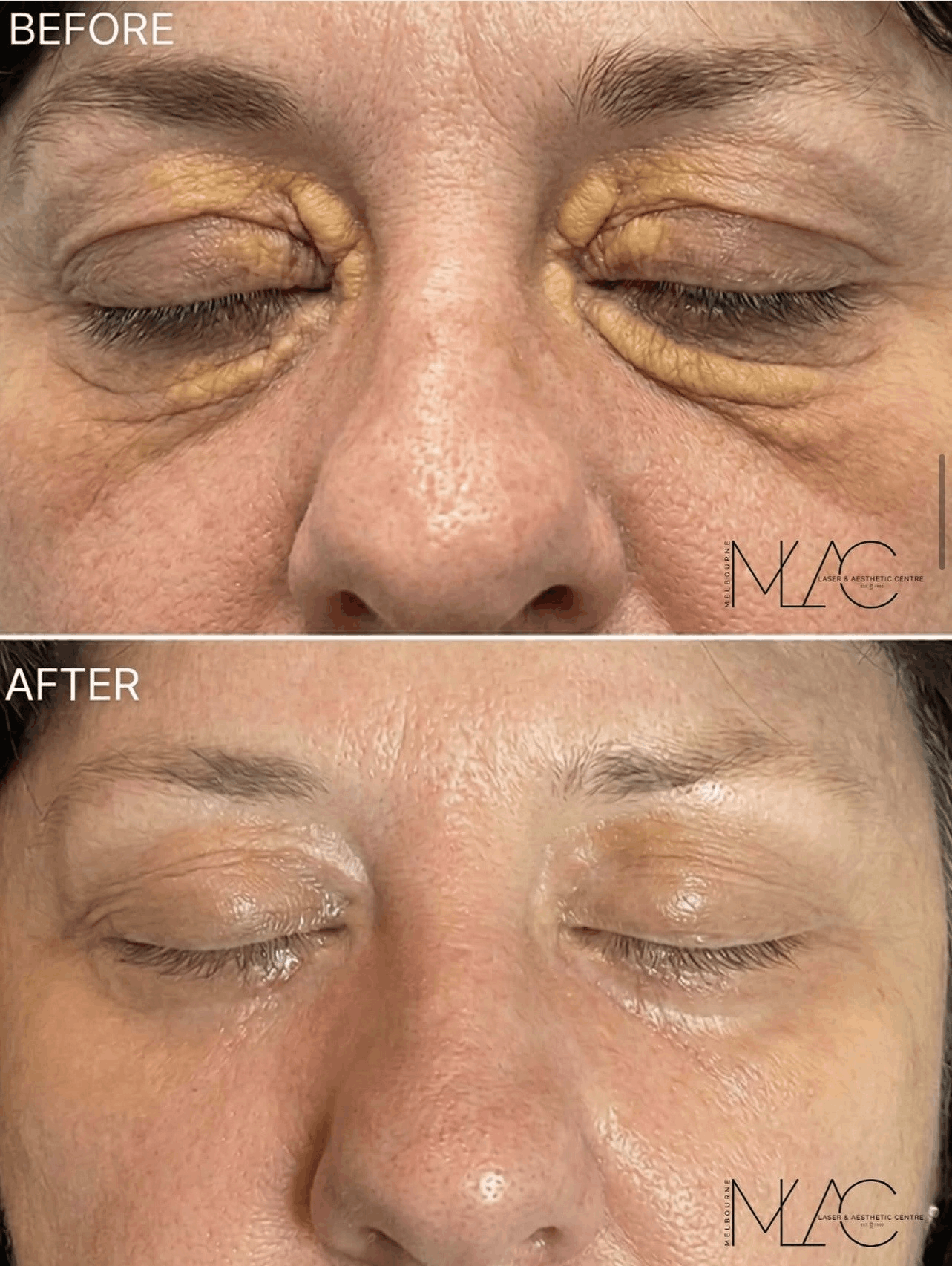 Xanthelasma Removal Melbourne Image